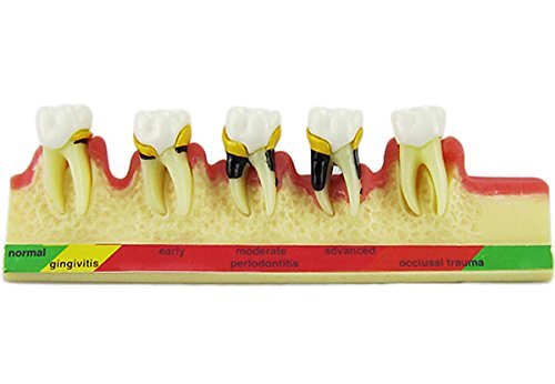Стоматологично Заболяване на Пародонта за разбиване на Зъб Типодонт зъбите Учат Обучающую Модел Нова